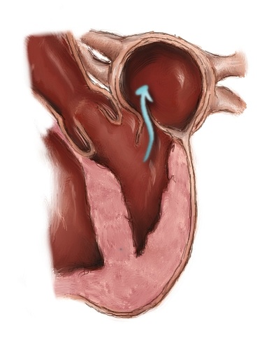 Mitral Valve Regurgitation