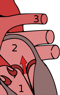 Mitral Valve Regurgitation
