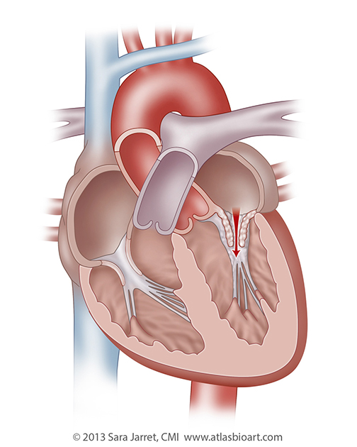 Mitral Valve Stenosis