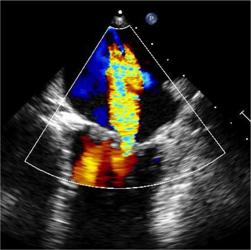 Transesophageal Echocardiogram Mitral Regurgitation